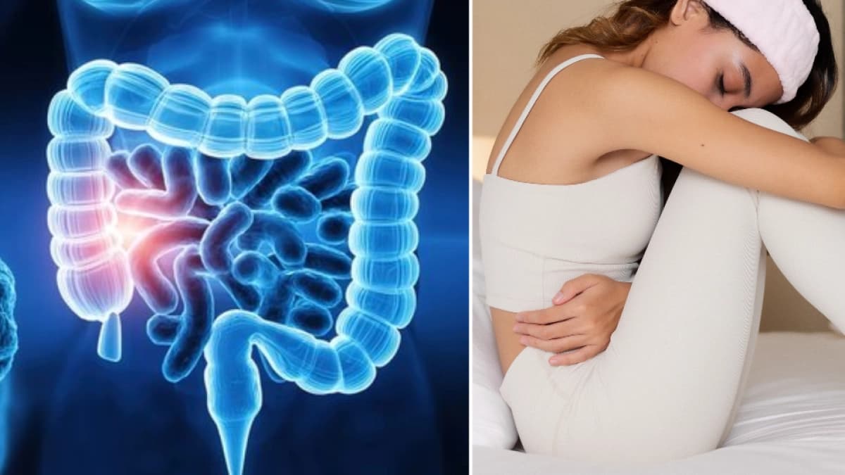 El Tiempo — Salud — Cáncer de colon en mujeres: siete síntomas que pueden confundirse con la menstruación, según estudios